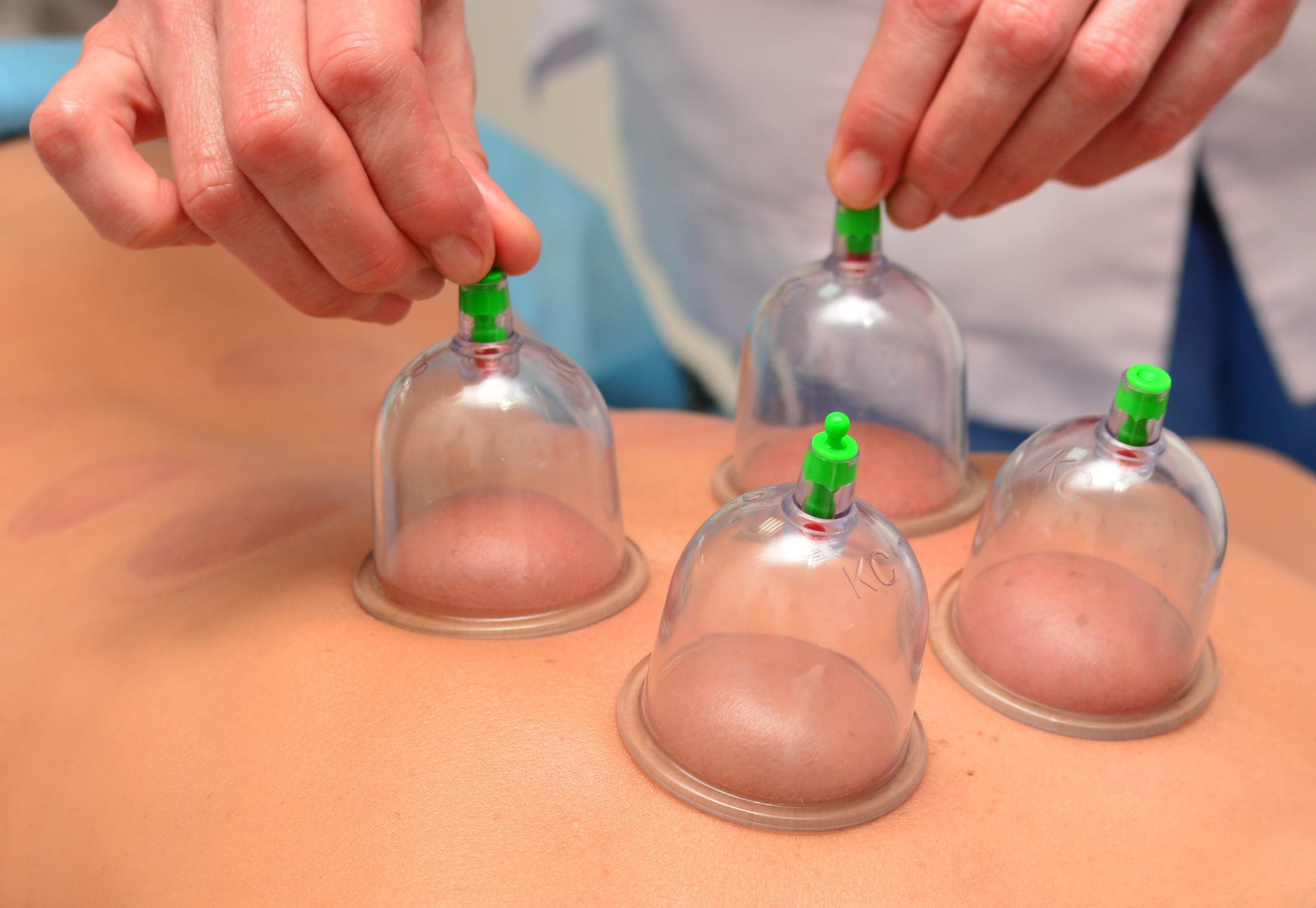 Cupping therapy on a client's back